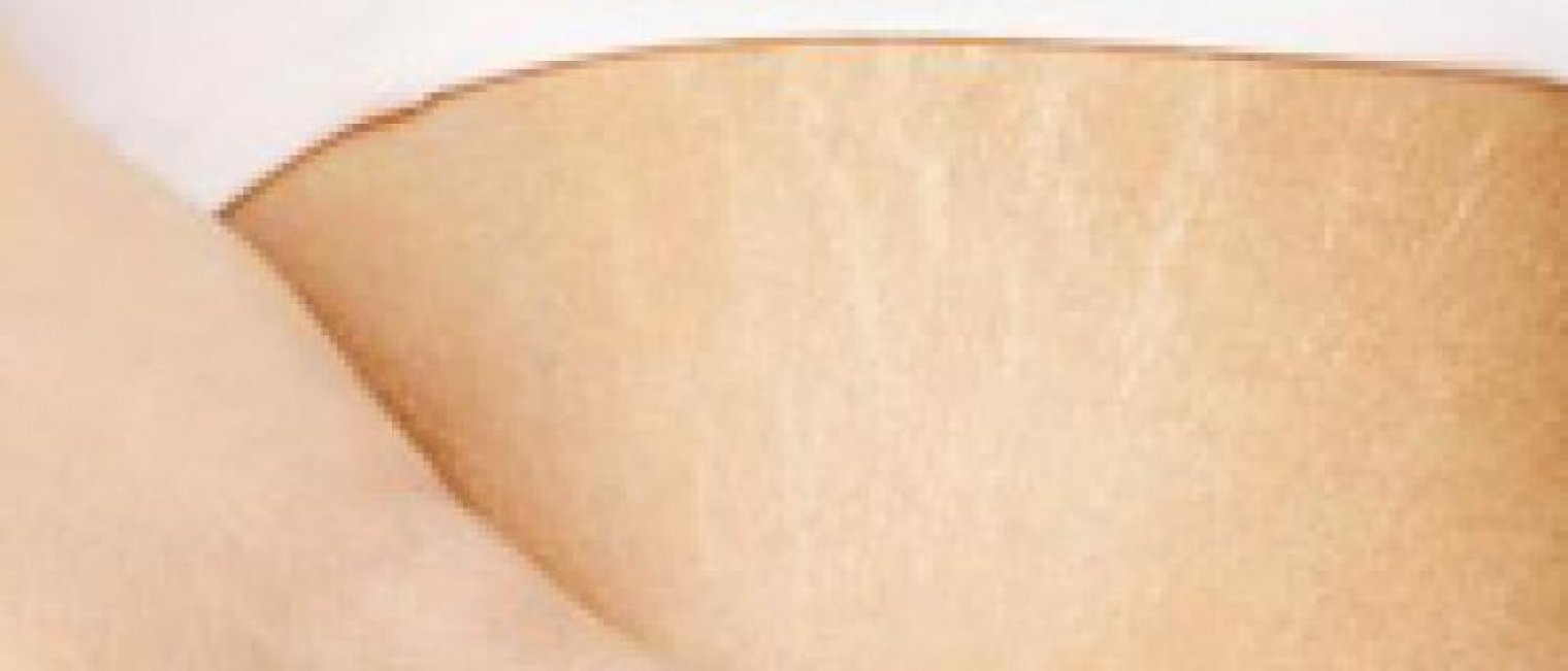 Kenapa Bisa Muncul Stretch Marks?