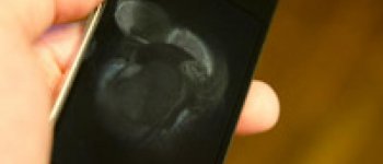 6 Kebiasaan yang Bisa Memperburuk Jerawatmu!