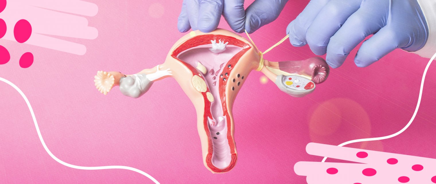 Ingin Tubektomi? Pelajari Efek Sampingnya Dulu, yuk!